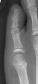 Toe Fractures-