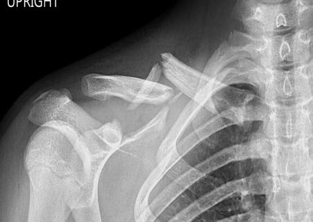Clavicle Under 12 years old surgery is never performed 13 and older surgery sometimes Surgical criteria