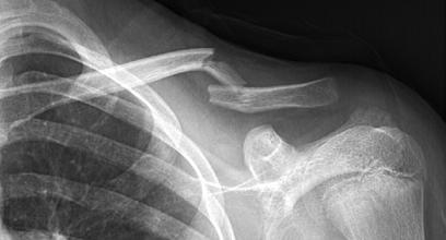 Clavicle fracture office management Sling for 4 weeks figure 8 brace if displaced,