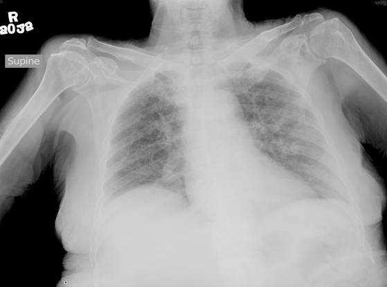 Chest X-ray on day 23 after admission showing the presence