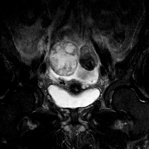 bladder Ascites T2 sagittal view pelvis