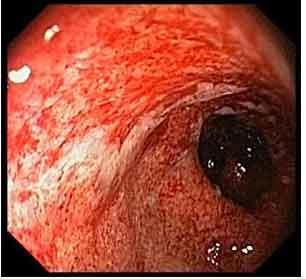 INFLAMMATORY BOWEL DISEASE Ulcerative Colitis Confluent erythema