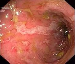 Crohn s Disease Patchy, asymmetric erythema Linear, serpiginous