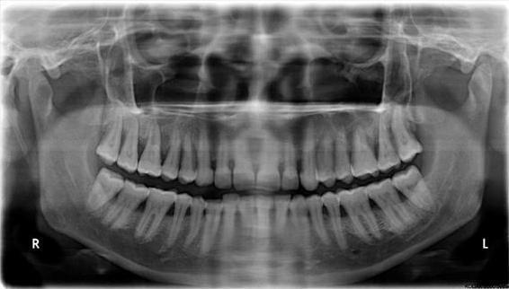 Figure 1: OPG showing normal mandibular cortex (C1) Materials and Methods Female subjects within the age group 50-72 yrs, who reported to the Dental Department of SGRRIM & HS, Dehradun, India, whose