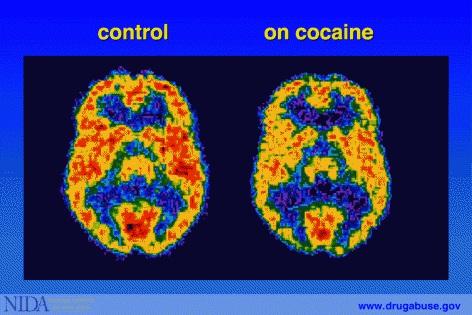 2: Positron emission tomography (PET) scan of a person using cocaine Cocaine has other actions in the brain in addition to activating the brain's reward circuitry.