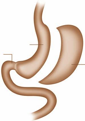 Illustration courtesy of A.R. Ahmed. Figure 2 The laparoscopic adjustable gastric band procedure. Illustration courtesy of A.R. Ahmed. Figure 3 The sleeve gastrectomy procedure.