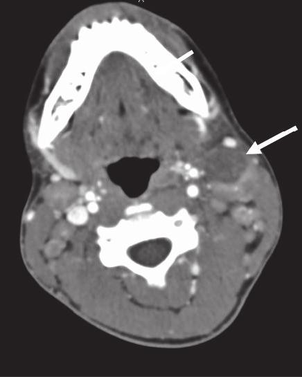 2 Case Reports in Radiology Figure 1: Axial CT angiogram showing bilateral cervical lymphadenopathy, the largest of which measures 4 3.4 2.5 cm (arrow).