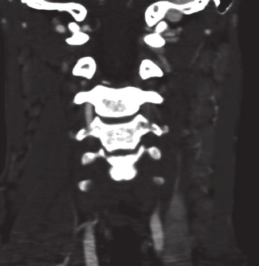 Figure 4: Ultrasound scan showing an enlarged left cervical lymph node with heterogeneous echogenicity.