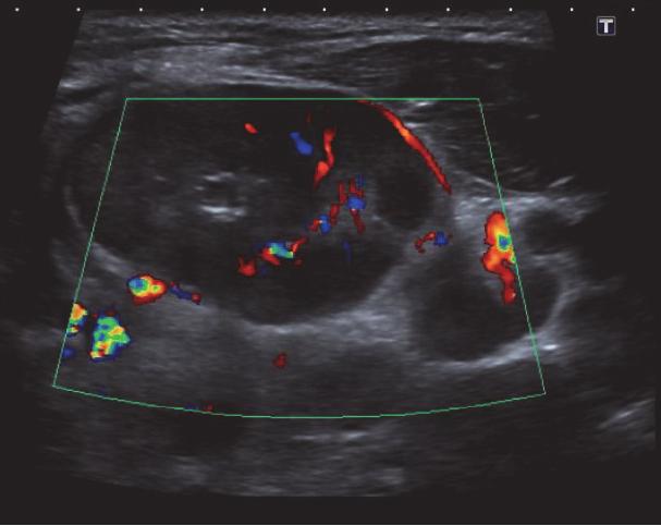 Case Reports in Radiology 3 Figure 5: Ultrasound scan of the lesion in question showing colour Doppler flow in the posterior aspect of the lesion only.