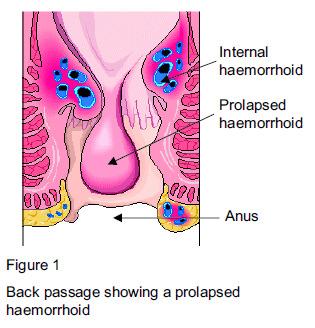 What are haemorrhoids? Haemorrhoids, also know as piles, are soft fleshy lumps just inside the back passage (anus).
