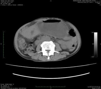 CT with oral IV contrast axial images 