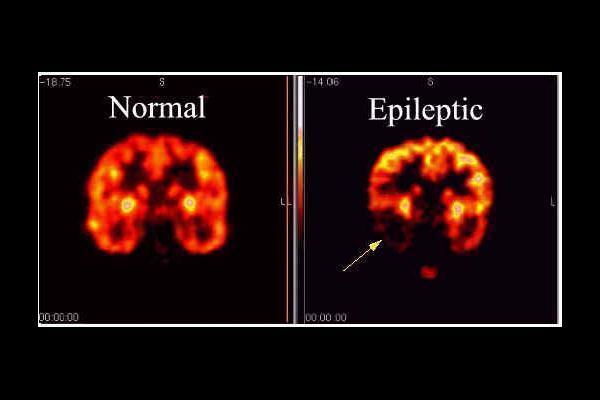 Epilepsy A condition in which a person has recurrent seizures due to an underlying chronic cause Incidence: 61 per 100,00 person-years Lifetime prevalence: 7.