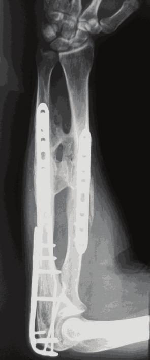 2 Case Reports in Orthopedics Figure 1: Right forearm in a 39-year-old man with a radioulnar synostosis type 2 18 months after the first surgery procedure for reduction and fixation of the fractures.