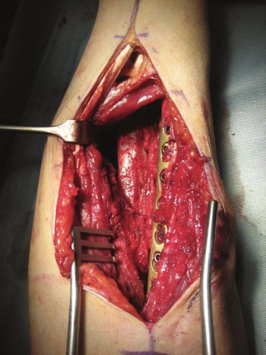 Case Reports in Orthopedics 3 Figure 3: Complete removal of the synostosis.
