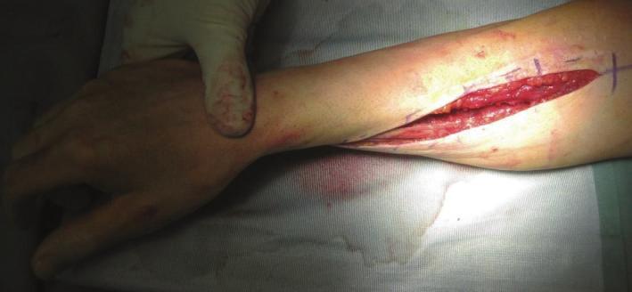 Figure 4: The pronosupination was complete immediately after excision and tested intraoperatively.