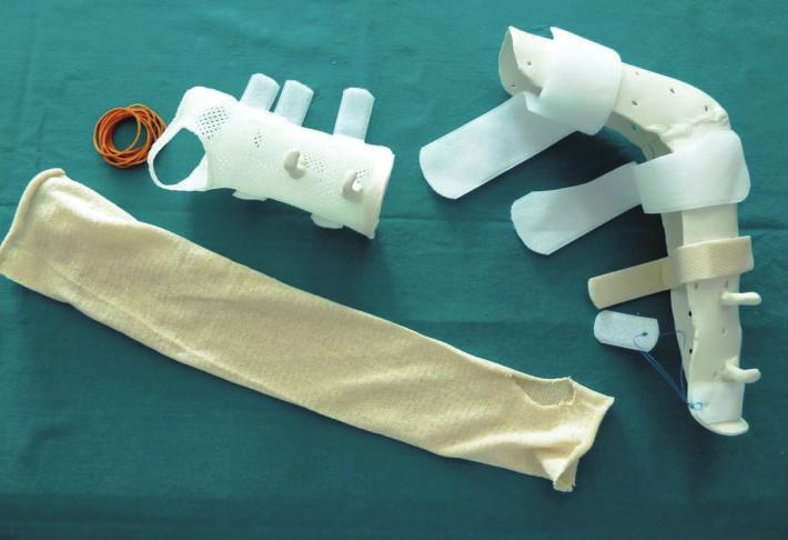 Initially, apart from frequent rehabilitation exercises, the splint was customized to act in static progressive mode.