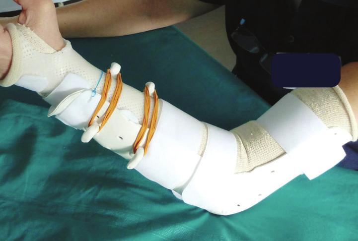 The aforementioned passive mobilization and customized splinting permitted the patients to regain 70% of the range of movement during the first month, while during the second