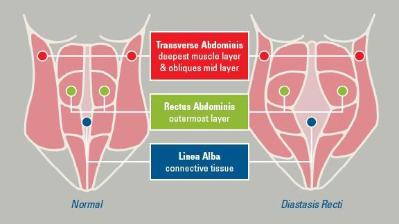 Abdominal muscles During pregnancy a combination of factors such as hormonal changes and abdominal muscles stretching as your baby grows can lead to a separation of the abdominal muscles called a