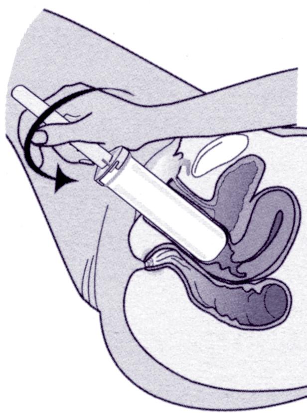 5. When the dilator is in as far as is comfortable, gently push it a little further and release.