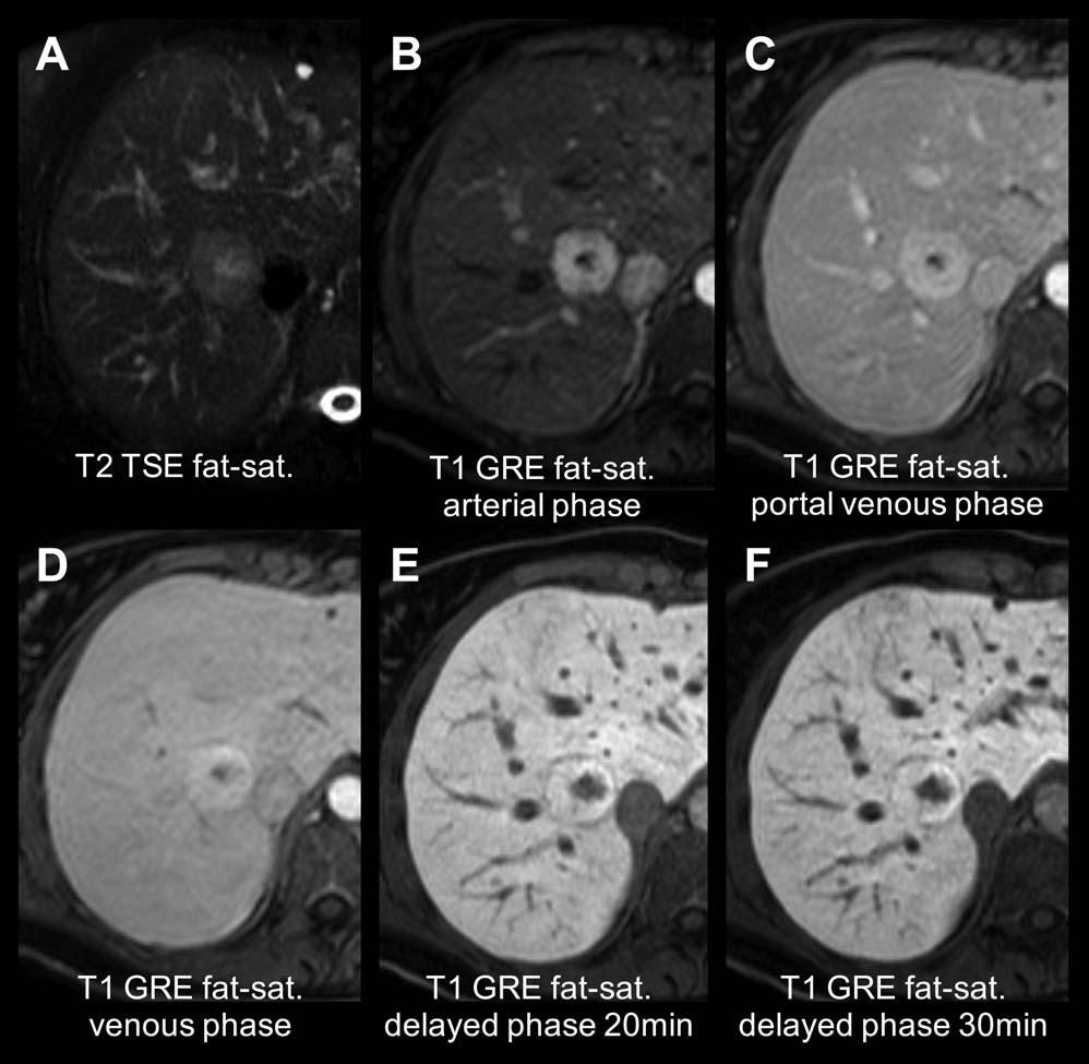 FIG 1 MRI of the liver using the hbgbca gadoxetic acid in a 23-year-old woman sent to characterize an incidental liver mass. A mass with a slight edema (A) in the right liver lobe can be appreciated.