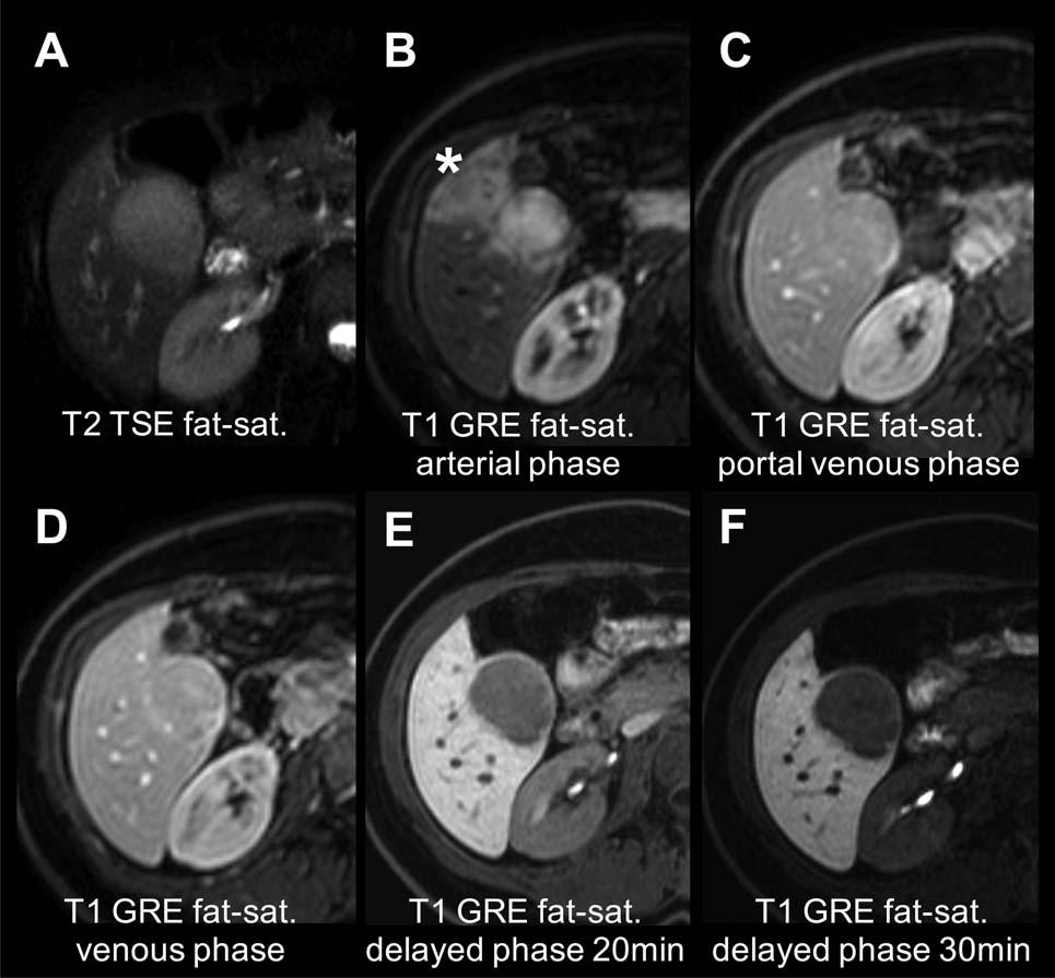 FIG 2 MRI characteristics of a histologically proven HA in a 31-year-old woman with gadoxetic acid--enhanced MRI.