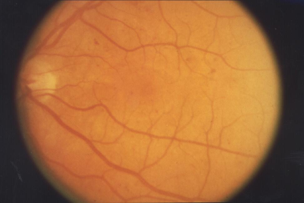 Non-proliferative diabetic retinopathy (NPDR): Non-proliferative diabetic retinopathy (NPDR) is the early stage of this disease.