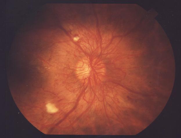 Proliferative diabetic retinopathy (PDR): The most advanced stage of diabetic retinopathy is proliferative diabetic retinopathy (PDR).