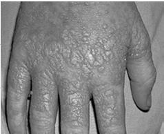 HCV infected patients with detectable cryoglobulins 1 Porphyria cutanea tarda (<5% of cases) 1 Lichen planus 1,2 Associated with liver disease, especially advanced hepatic disorders The relationship
