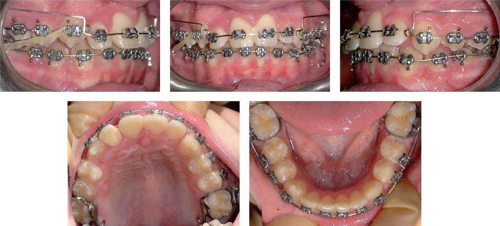 Management of three impacted teeth