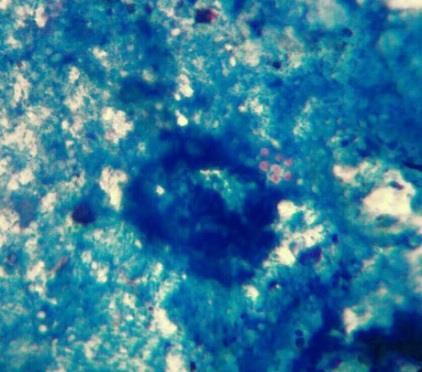 2: Stool samples stained with Modified Zeihl -Neelsen stain showing Cryptosporidium oocyst (x40 and x100) Fig.