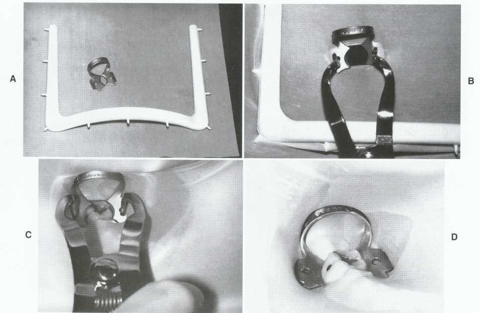 Fig. 5-36 A, Rubber dam, clamp, and frame. B, Clamp positioned in the dam with frame attached and held in position with rubber dam forceps.