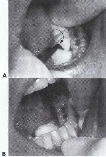 vestibule adjacent to teeth. Figure 6.