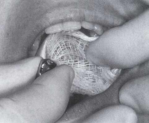 IV-Throat shields or throat screens (gauze sponges). Figure 8.