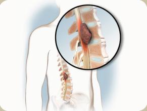 3,4 Serious bone problems are: Spinal cord compression, which occurs when cancer grows in