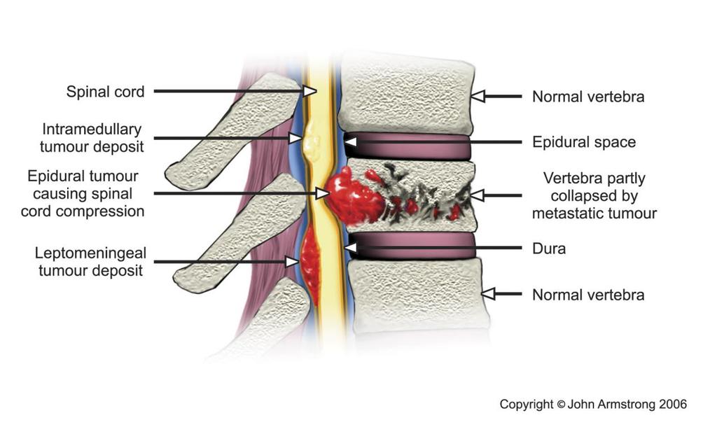 1 Introduction Metastatic spinal cord compression (MSCC) is defined in this guideline as spinal cord or cauda equina compression by direct pressure and/or induction of vertebral collapse or