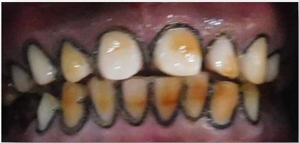 premolar(maxillary and mandibular teeth) Fig
