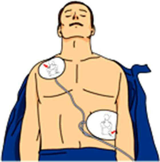 Pads have replaced paddles in most applications of defibrillators.