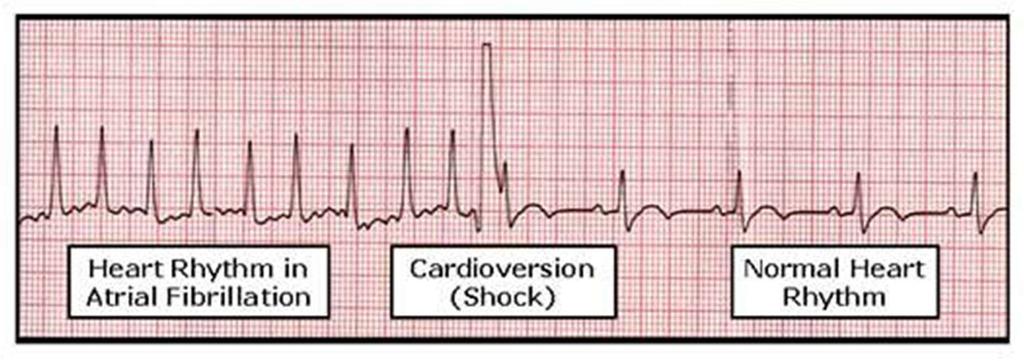 Defibs for Cardioversion (this is not defibrillation!) > The use of a small energy