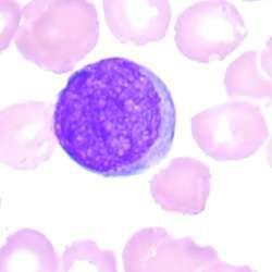 Acute Myeloid Leukemia Defined >20 BLASTS in