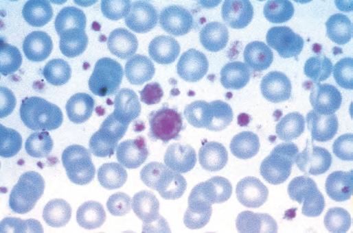 o Clinical presentation: rare disease that presents with significant thrombocytosis.