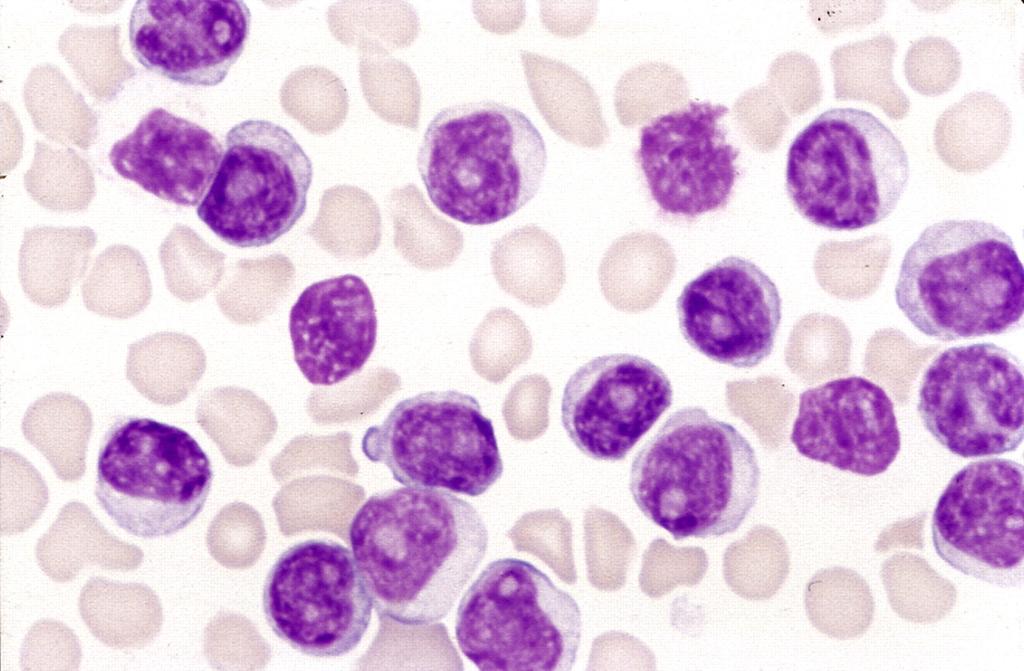 ! Note the abundant blasts, to diagnose AML you need to count 500 cells in the bone marrow and calculate the percentage of blasts; if they are 20% or more, this is AML.