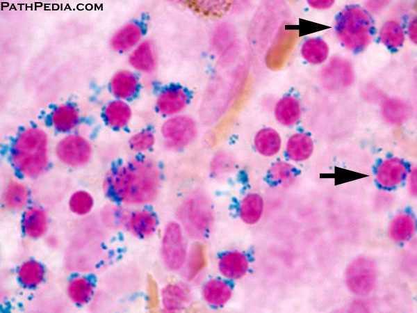 Note the erythroid dysplasia in the form of irregular nucleus (cell on the left) and nuclear budding