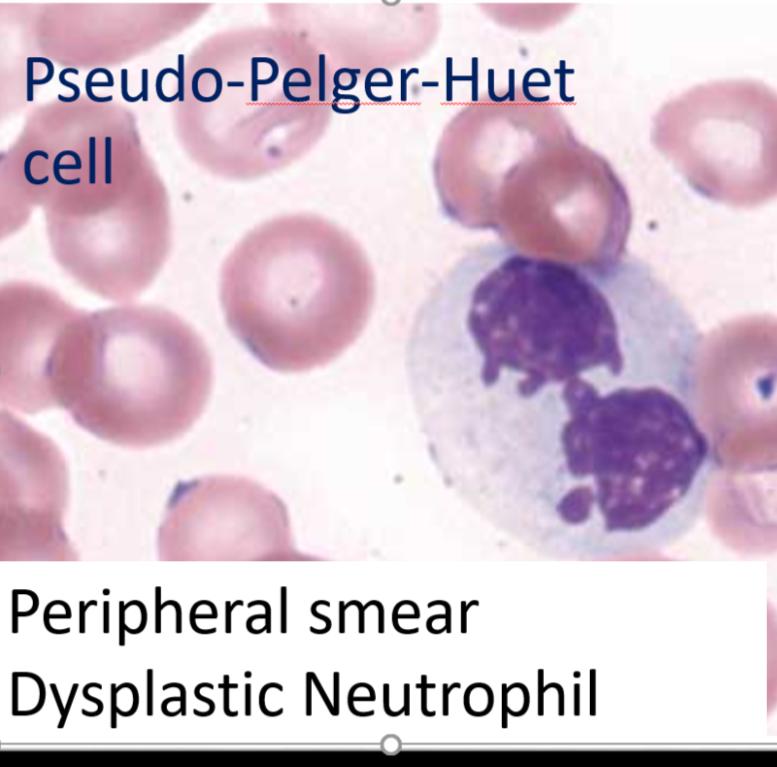 Note the presence of a neutrophil with only one lobe (lower cell), also note the presence of a blast