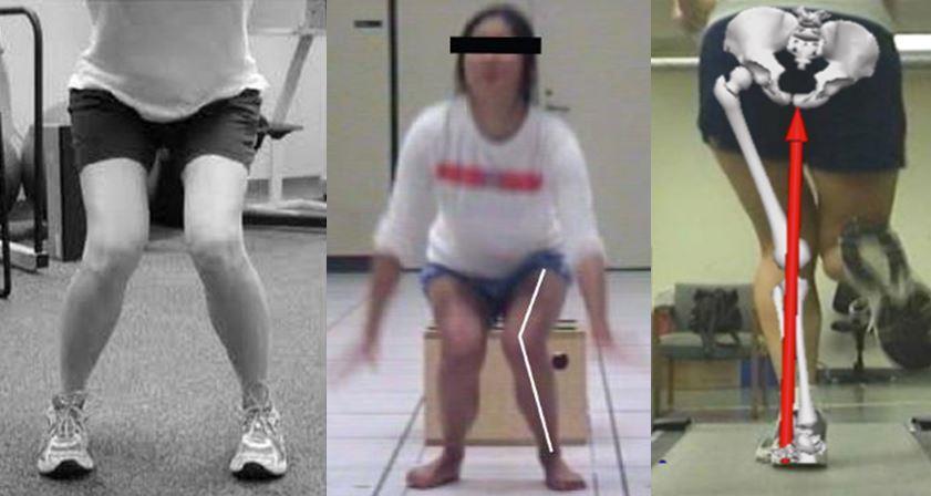 Figure 1: Knee collapse in loading, landing, running and standing positions. Figure 2: Normal Knee alignment.