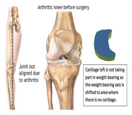 Many kids are prescribed orthotics because of the fallen arch.