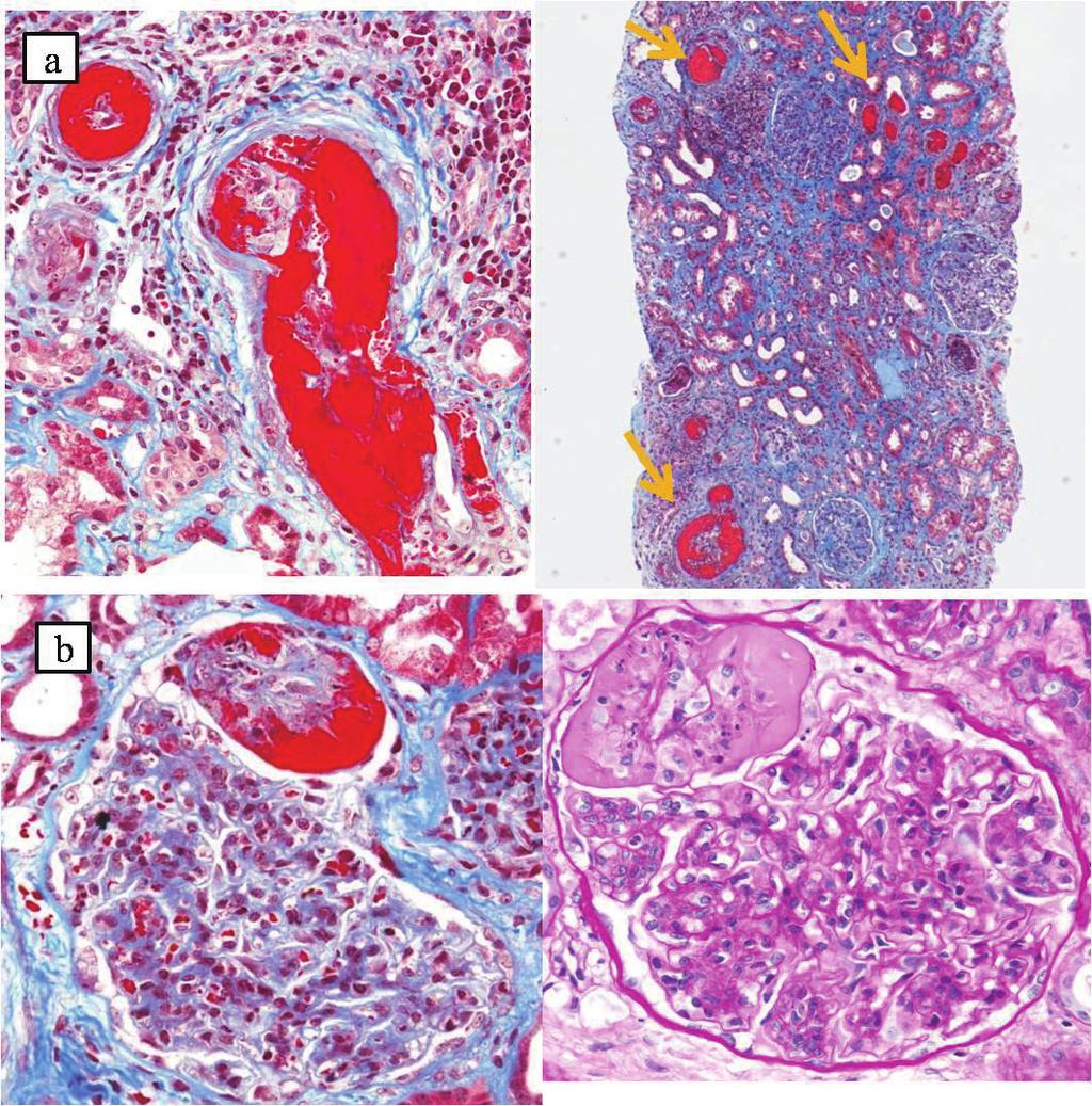 Figure 2. Histological examination of kidney. a. Renal biopsy specimen. Fibrin thrombi in arterioles were found (arrows).