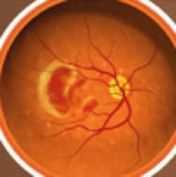 Information for Patients Manchester Royal Eye Hospital Medical Retina Services Treatment of Age Related Macular Degeneration (AMD) by Intravitreal Injection What is age related macular degeneration