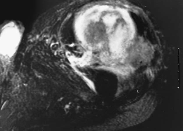 Fig. 2 T2-weighted axial MR image showing a myxoid liposarcoma in the proximal thigh which was excised with a planned positive margin along the femoral artery.