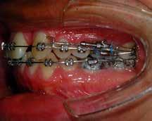 past orthodontic treatment.