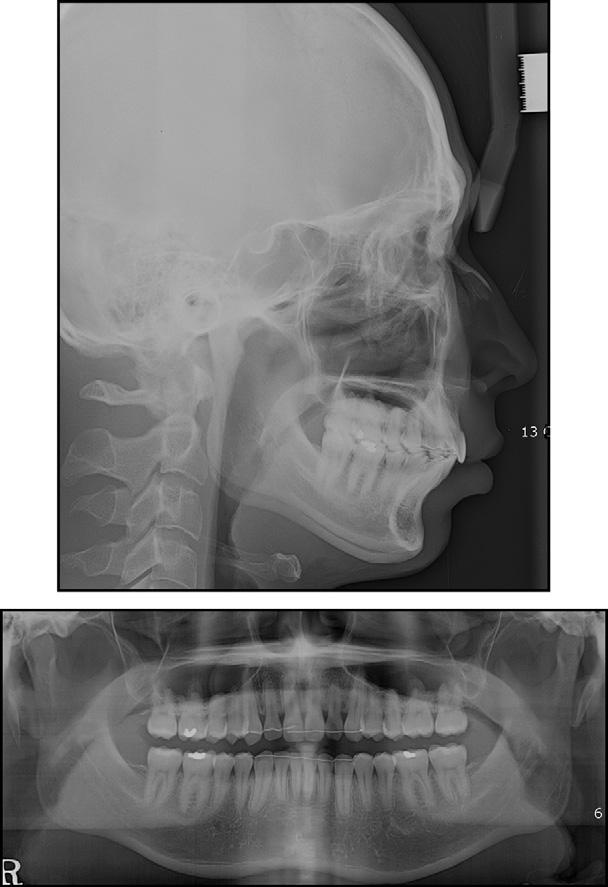 832 Choi et al Fig 14. Miniscrew implants above the second premolar after distalization of the molars. Fig 13. Lateral cephalogram and panoramic radiograph.
